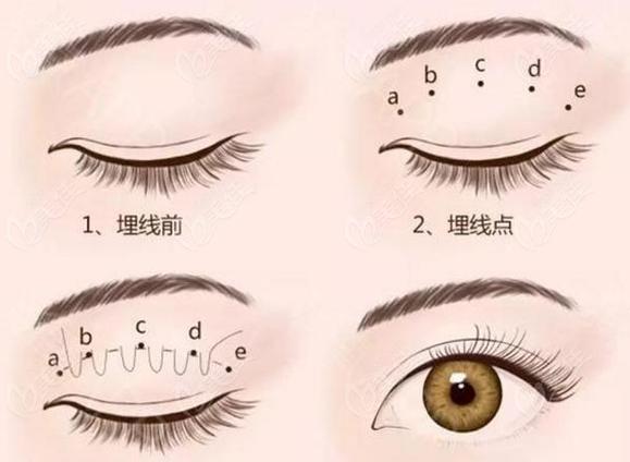 邯郸第三医院埋线双眼皮价格及医生推荐，满足你的整形需求